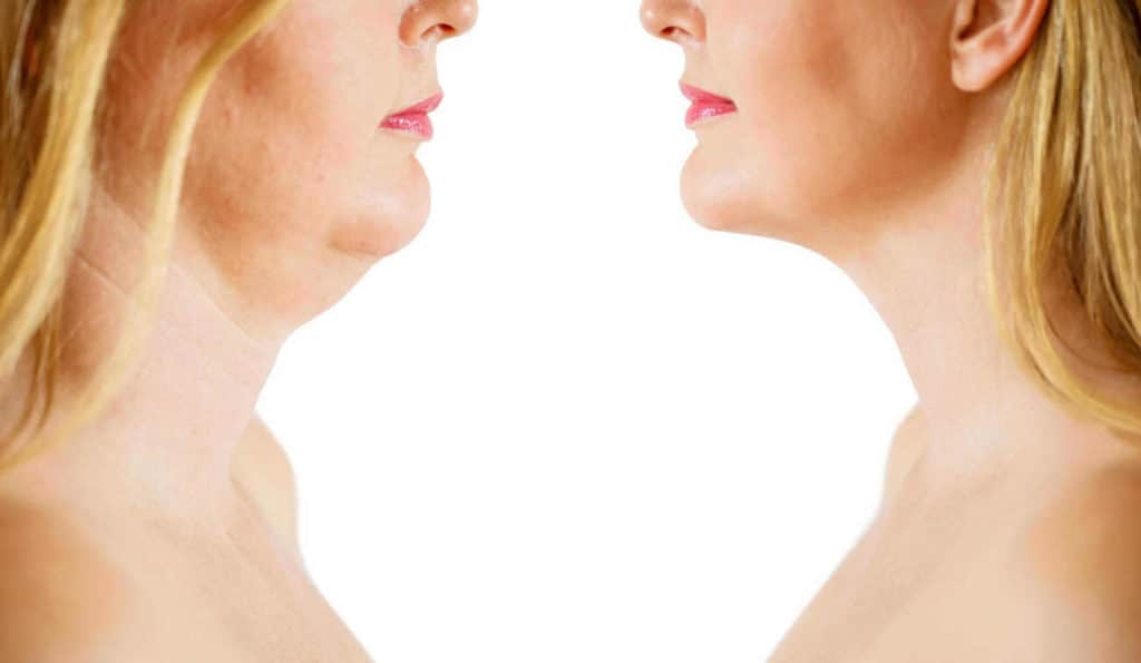 Double Chin treatment New Malden before and after results