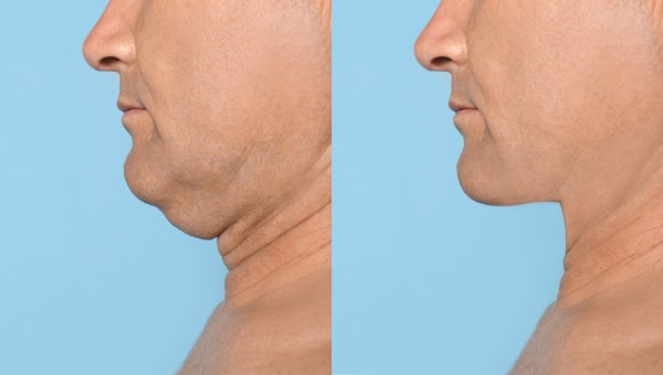 Which Non-Surgical Treatments Work Best for Jowls and Loose Skin New Malden?