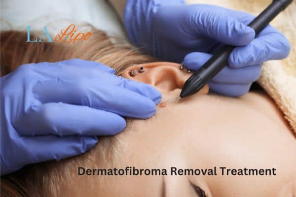 Dermatofibroma Removal Treatment New Malden