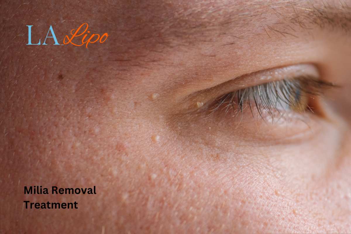 Cryopen Milia Removal: Is It the Easiest and Safest Option New Malden?