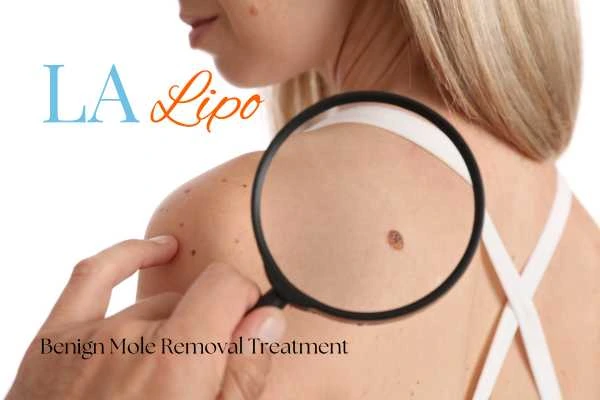 Woman having her inspection of blemish before mole removal New Malden