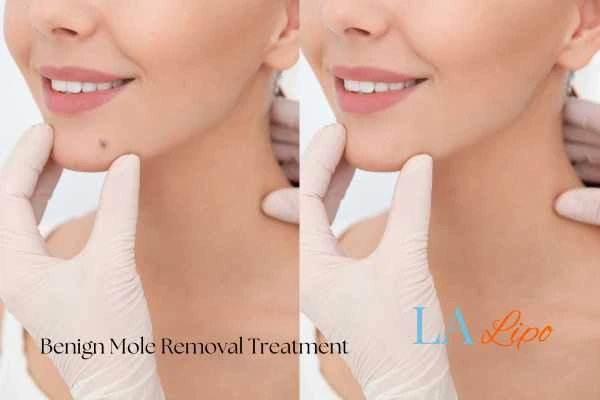 woman's before and after mole removal New Malden results