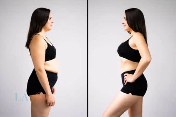 image of woman before and after results of LA-EMS Body Sculpting New Malden to help treat Diastasis recti