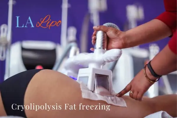 women getting fat freezing New Malden