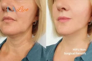 hi-fu for wrinkles New Malden before and after results