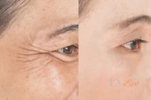 Before and after results of woman - HI-fu wrinkles reduction treatment New Malden