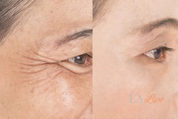 Before and after results of woman - HI-fu wrinkles reduction treatment New Malden