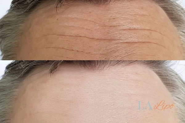 results of HIFU New Malden on mans forehead to help reduce lines and wrinkles