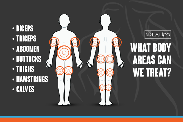 Graphic to show areas you can have LA-EMS Body Sculpting New Malden treatment.