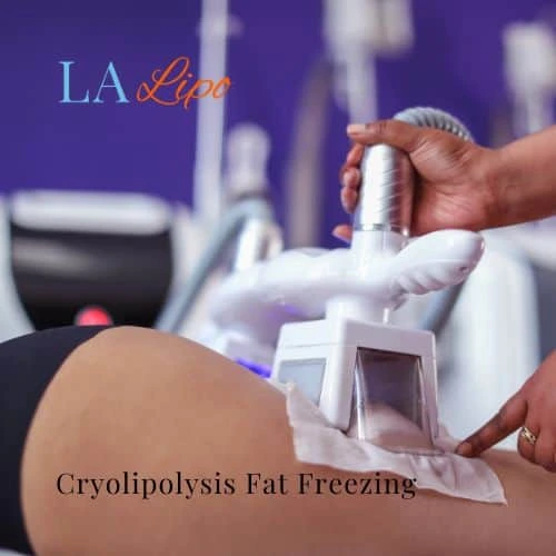 fat freezing - Cryolipolysis New Malden
