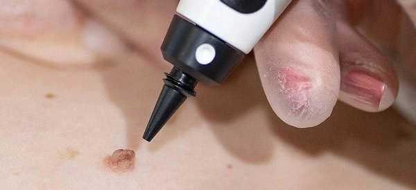 skin tag removal using cryopen New Malden