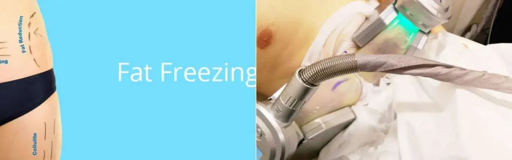 multi areas of a persons body having coolsculpting New Malden treatment