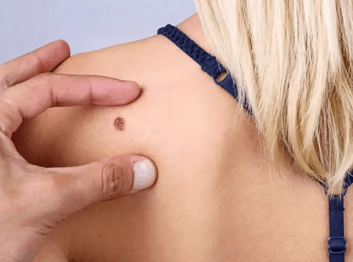 woman having mole removal New Malden consultation before treatment.