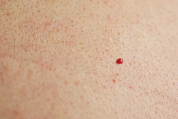 close up of a cherry angioma New Malden