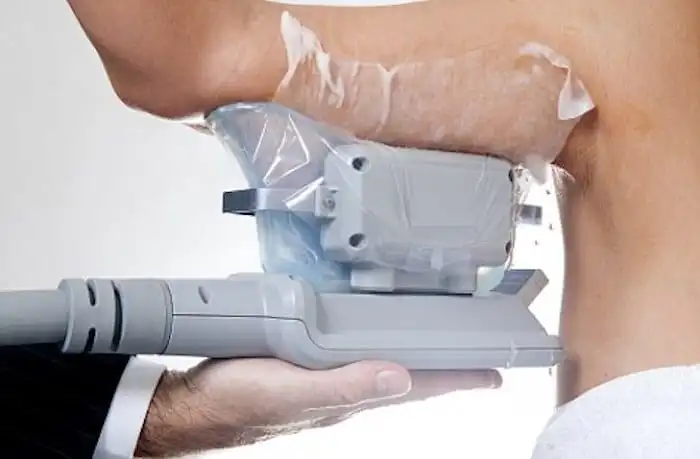 Picture of fat freezing New Malden on the upper arms.