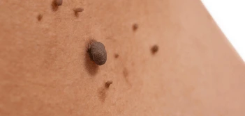 image of a skin tag New Malden