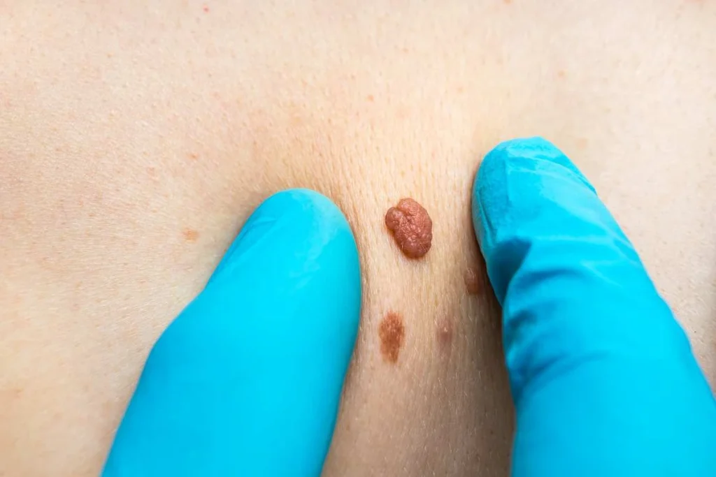 Consultant examining a skin tag New Malden