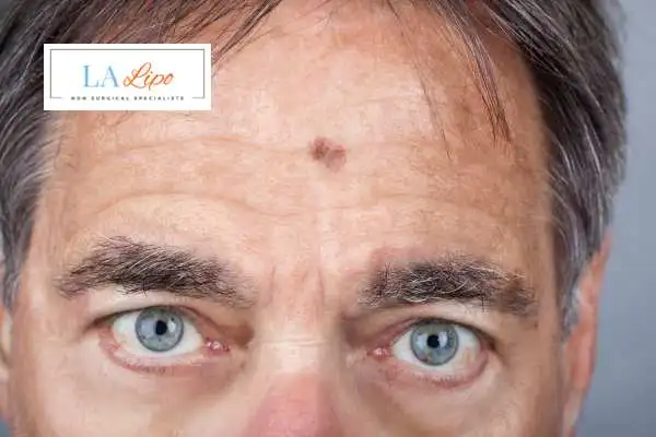 Solar Lentigo Removal New Malden image of man with mark on his forehead