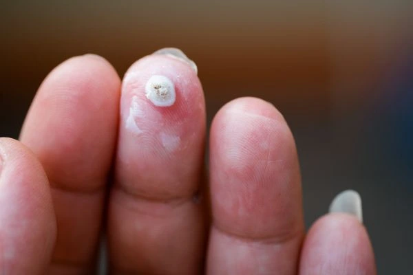 wart on person finger - cryotherapy to treat from LA LIPO New Malden