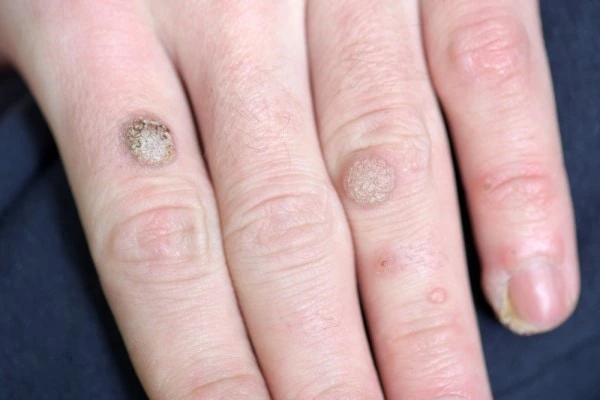 photo of warts on person hand - see wart removal New Malden from LA LIPO