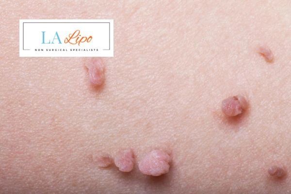 Does cryopen skin tag removal New Malden hurt? Find out now call our team today!