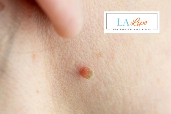 Book skin tag removal New Malden today speak to our team now!