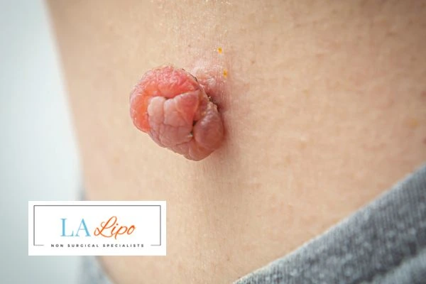 Interested in skin tag removal New Malden? Concerned about the pain? Find out more today!