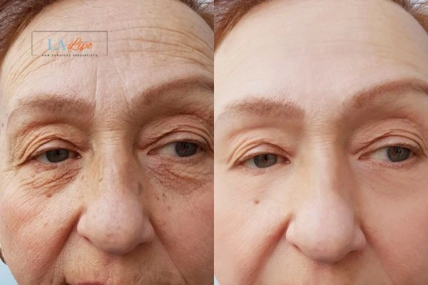 The powerful benefits of Morpheus8 Treatment New Malden - Call Our team today!
