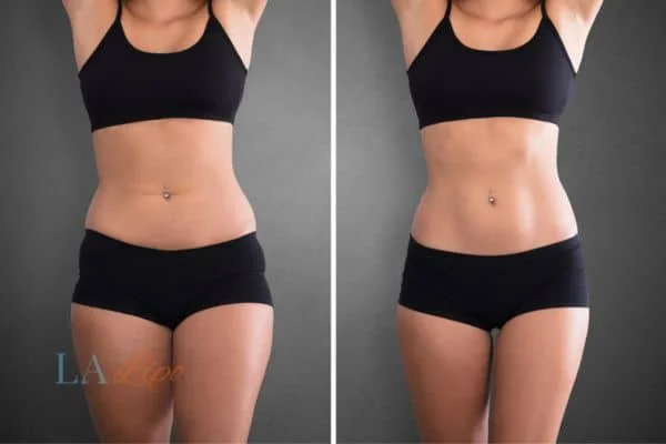 before and after results of non-surgical treatment to help a woman's body image and mental health New Malden