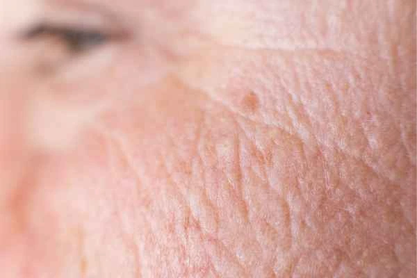close up picture of a woman's face showing an age spot New Malden