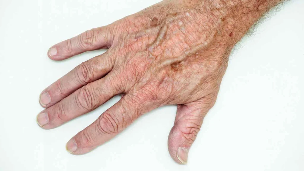 Male hand showing age spot New Malden