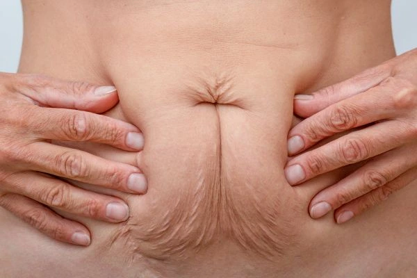 Image of a woman's stomach with loose skin - example of skin tightening New Malden options