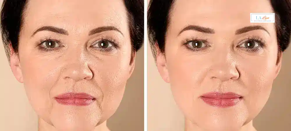 How Long Does It Take to See Results and How Long Do They Last New Malden?