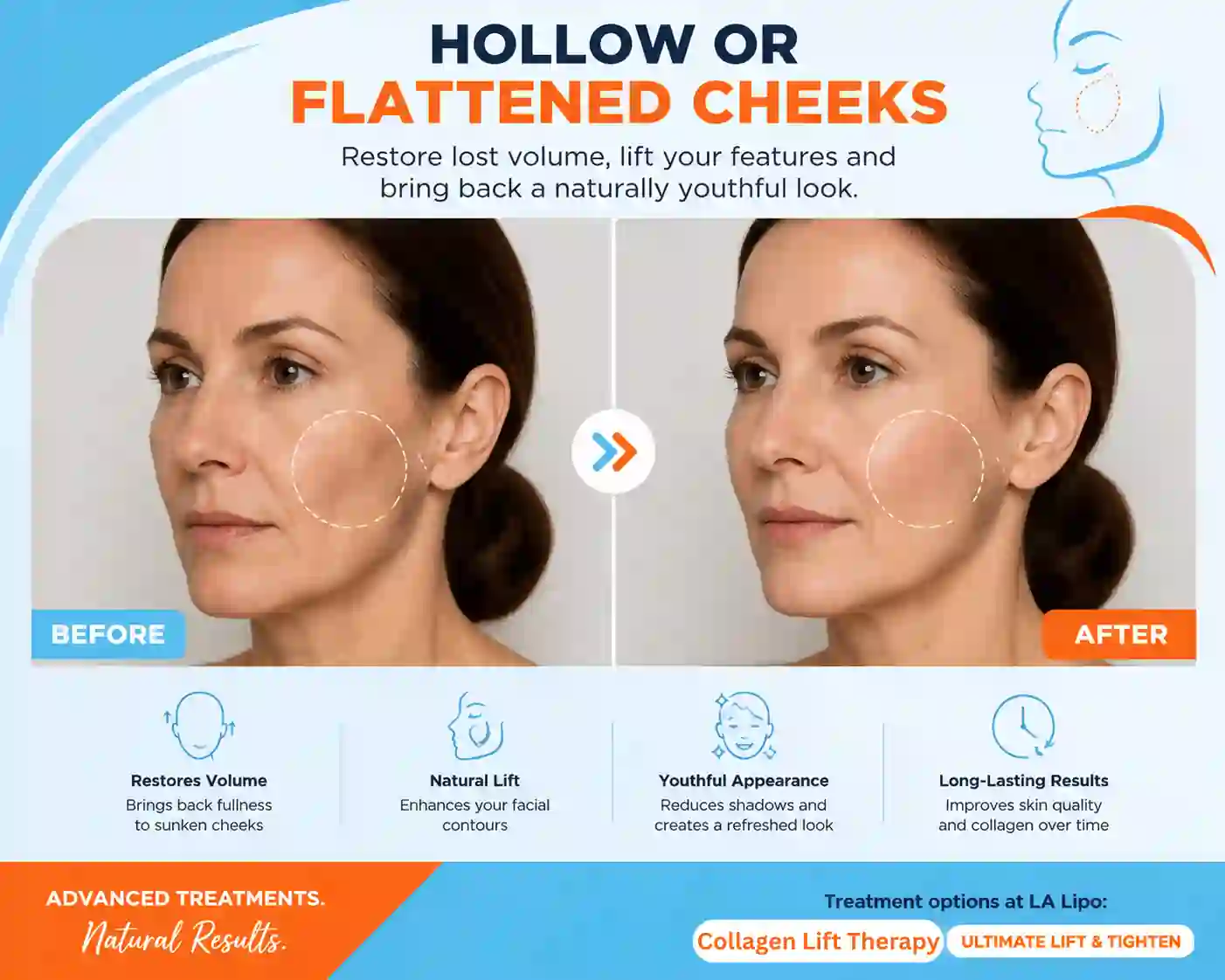 Sign #4: Hollow or Flattened Cheeks New Malden